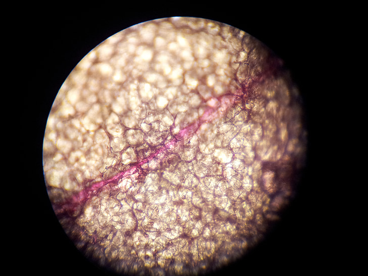 Nuova speranza per i pazienti con mieloma multiplo: il Belantamab arriva al Cardarelli