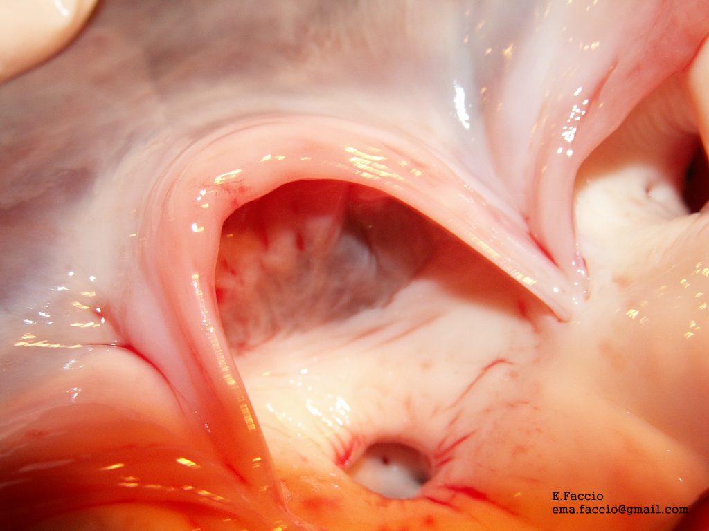 Un intervento cardiochirurgico senza precedenti a Salerno: triplo trapianto valvolare